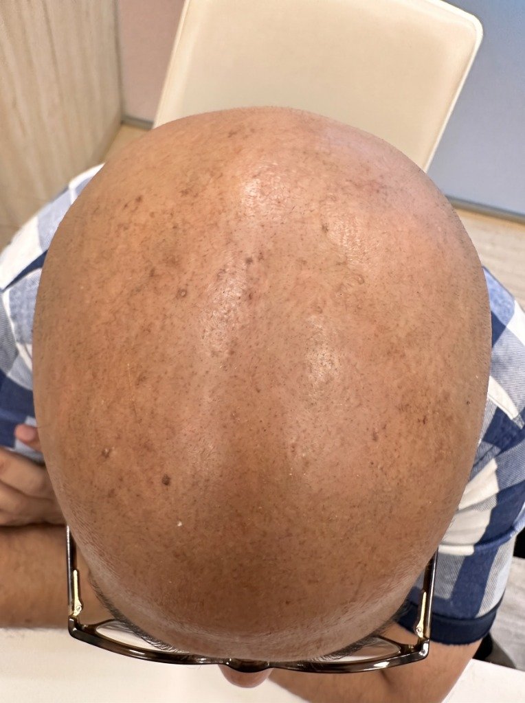 Before Treatment