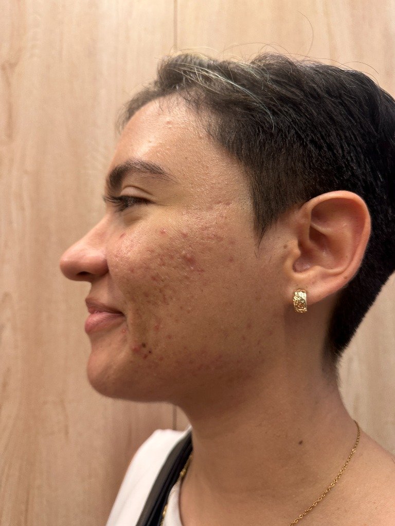 Before Treatment